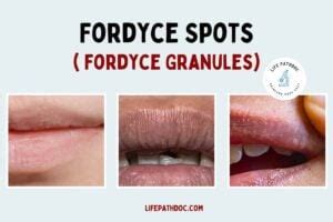 grain de fordyce|Fordyce Spots: Identification, Causes & Treatment